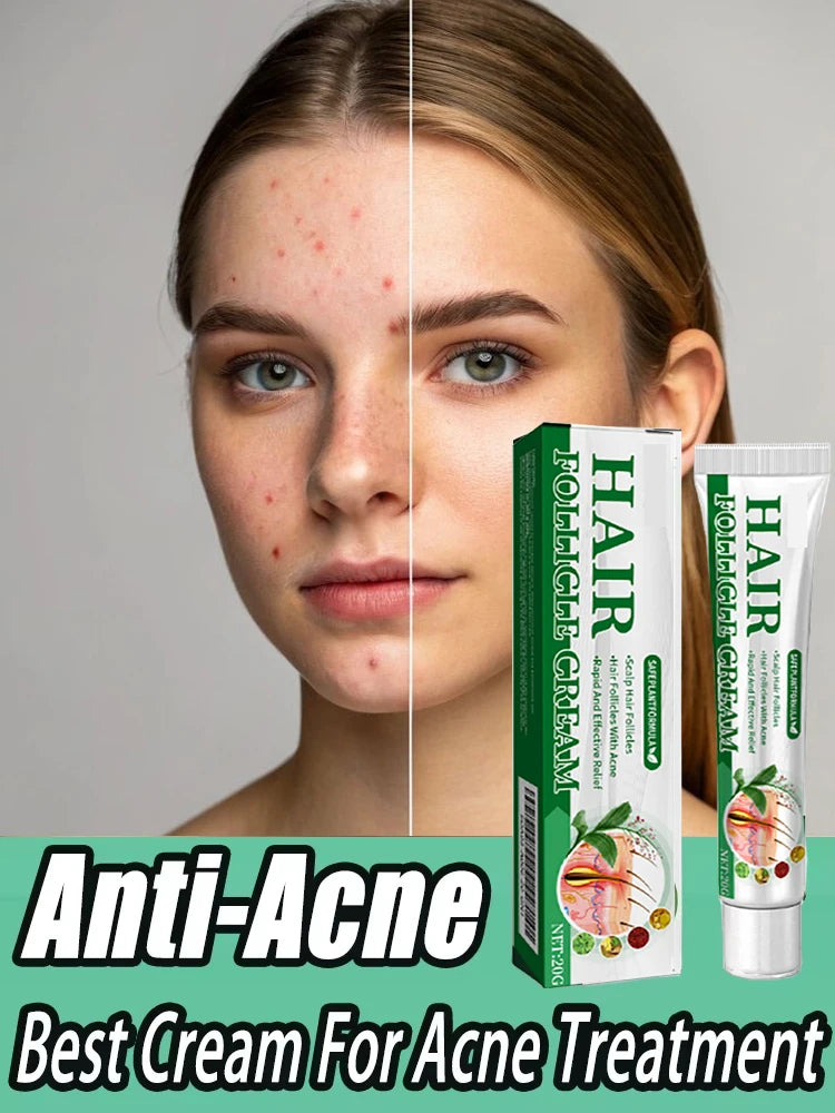 3RD Anti-Acne Essence Cream