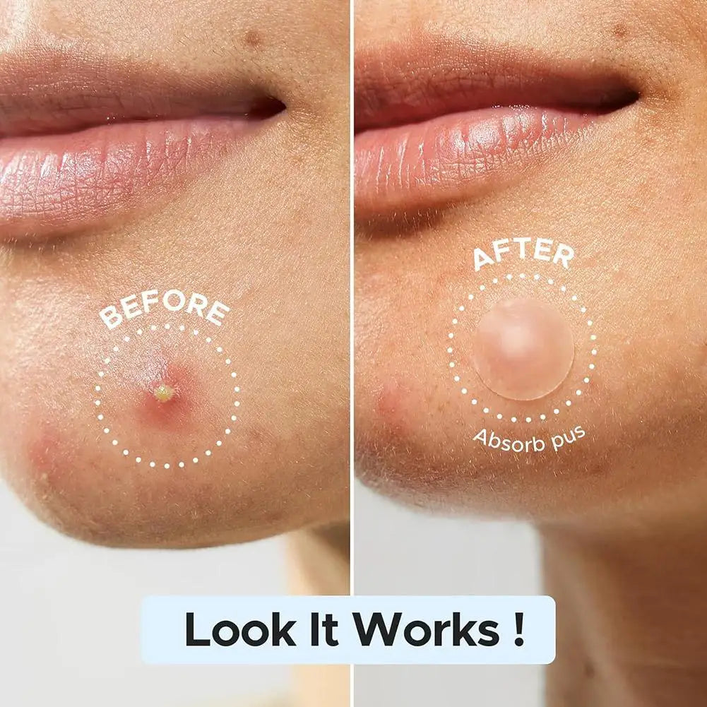 Large Pimple Patches for Face