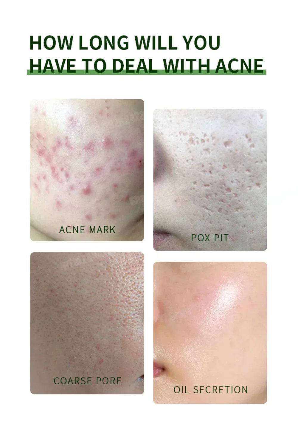 3RD Anti-Acne Essence Cream