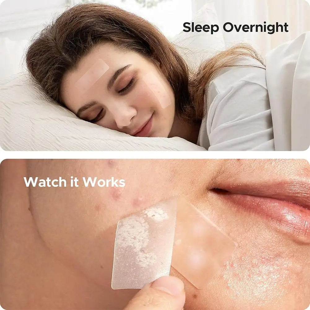 Large Pimple Patches for Face