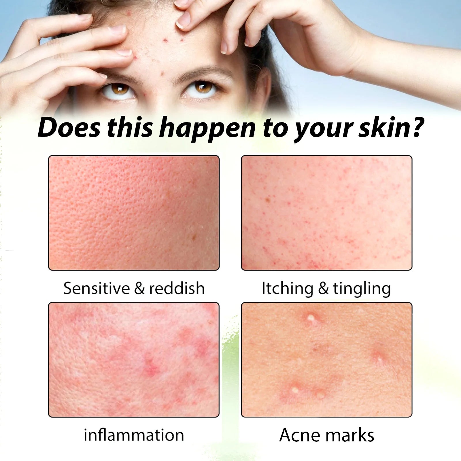 3RD Anti-Acne Essence Cream